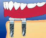 入れ歯を固定するときのイメージ