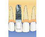 上顎前歯の症例イメージ