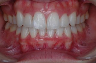 矯正後の歯並び