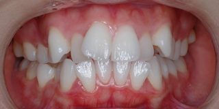 矯正前の歯並び